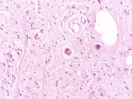 hyperchromatic cells in sclerotic areas Infrequent mitoses, moderate