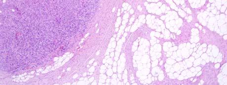 Dedifferentiated Liposarcoma May present as any non-adipocytic sarcoma, MFH most common Most retroperitoneal MFHs represent dediff.