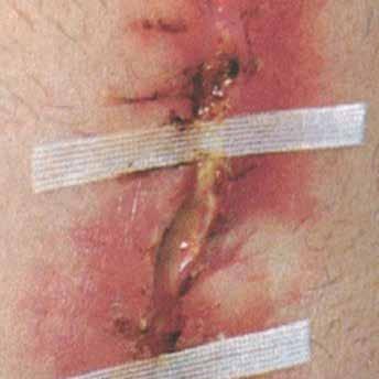 The role of debridement in bioburden management Chronic wounds are typically stuck in the inflammatory phase of healing and are at a higher risk of