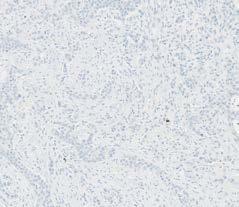 1% and < 5% Low expression in urothelial carcinoma tissue, 10x Low expression in