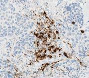 without aggregates IC single-cell spread Urothelial carcinoma tissue, 10x