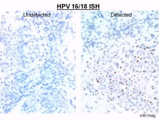Amplification System) using biotinylated probes for HPV16/18 p16 IHC (DAKO autostainer