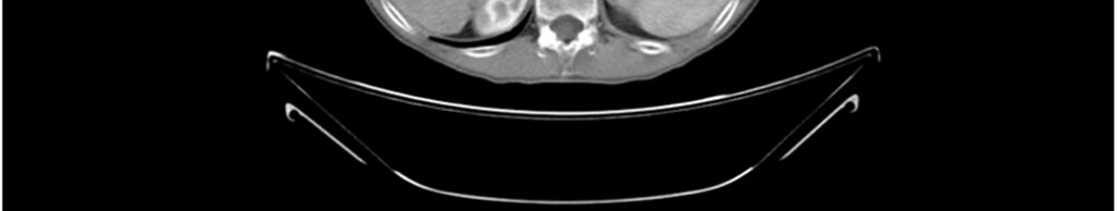 Extrapancreatic somatostatinomas are malign tumours, but they are generally smaller and less often associated with metastases than pancreatic somatostatinomas.