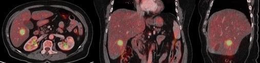 PET Scan and Liver resection