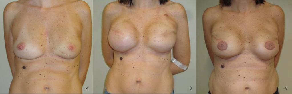 Reconstruction in irradiated patients Figure 3. Case of 10-year experience on immediate expander reconstruction after salvage mastectomy.
