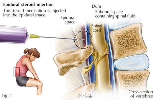 Injections Epidural injections : Most common Facet