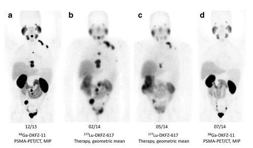 Radionuclide Treatment in CRPC The future Beyond bone-seeking agents Theranostics