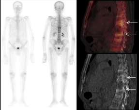 Figure 5: 50 year old male with Squamous cell carcinoma of esophagus underwent bone scintigraphy due to hypercalcemia [ionized calcium = 1.