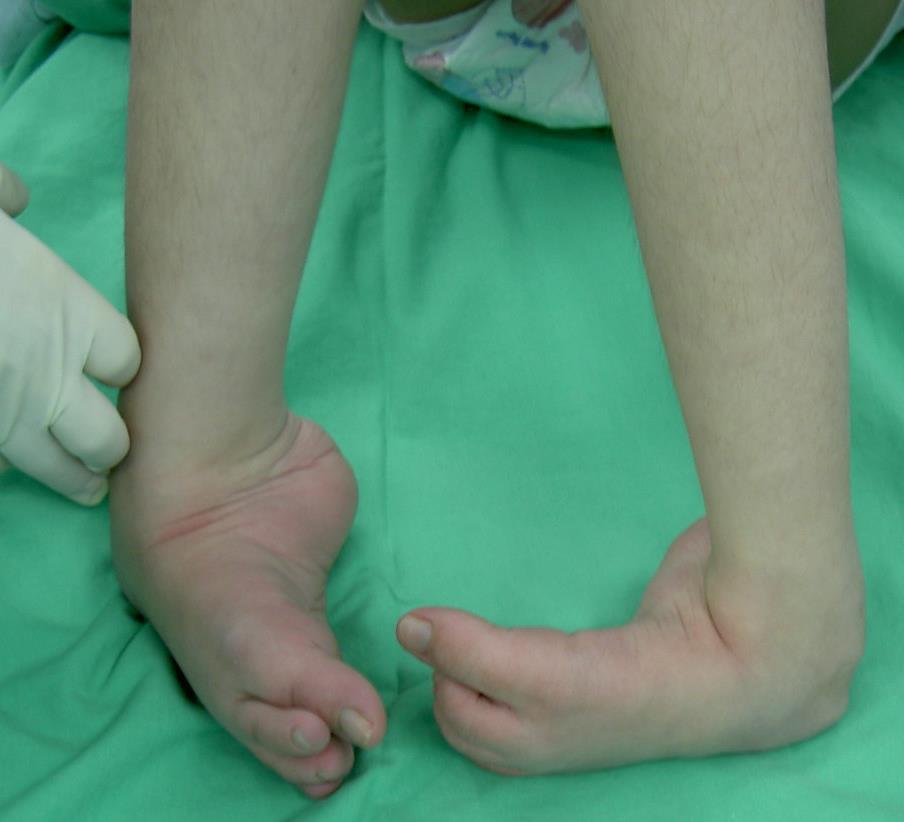 Case II: : A 15-Year-Old Girl with Rigid Joints Deformity