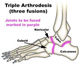 A triple arthrodesis consists of surgical fusion of the talocalcaneal
