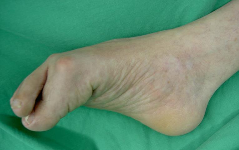 Foot, Subluxation of