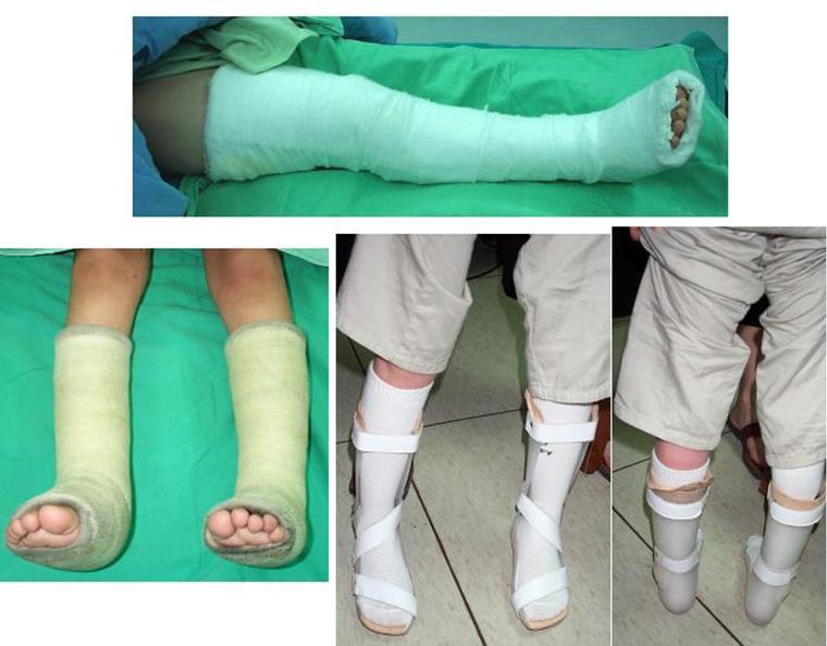 The leg splint was removed ten days after op.