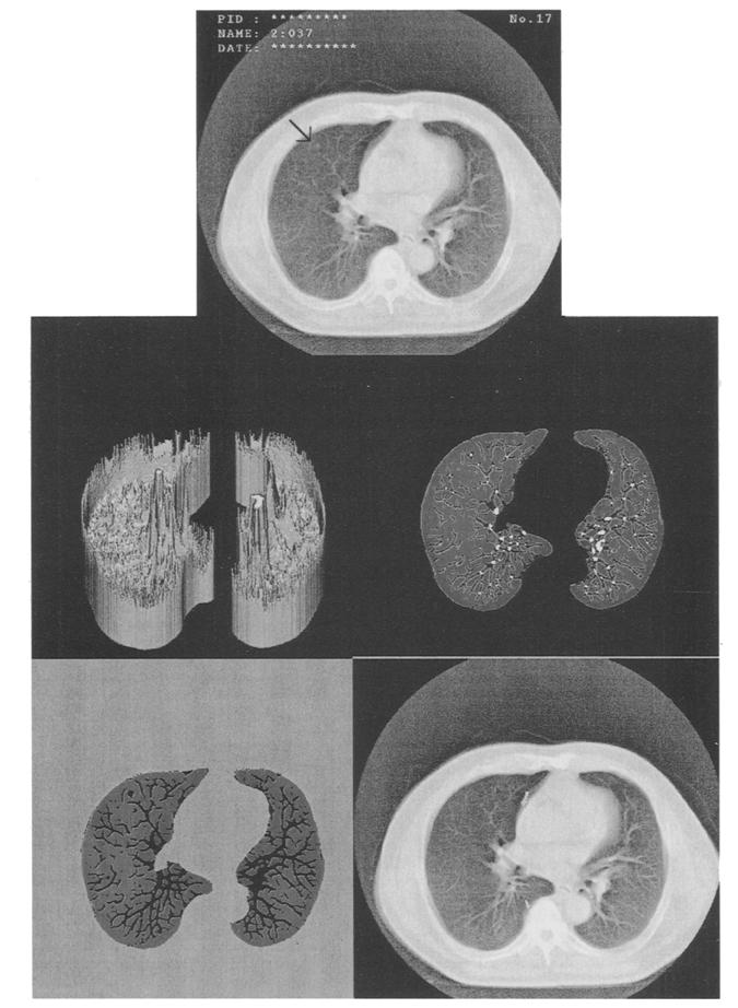 426 Fig. 1 Application result of the improved method. (a) Original chest CT image. The arrow denotes the candidate of lung cancer specified by the physicians.