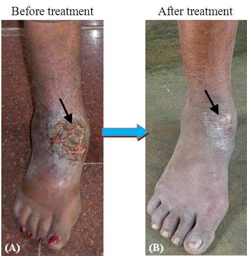 arm before (A) and after (B) treatment with milterfosine