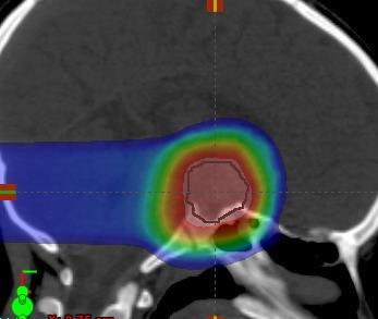 DATA: ~850 pediatric brain tumors treated, including >100