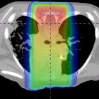 Medulloblastoma: Craniospinal Axis Irradiation: Photons & 3DCRT