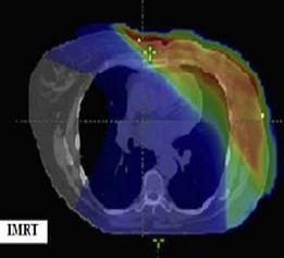 Breast Cancer: IMRT and PT IMRT 3DPT Mean heart dose 5 Gy 1Gy Xu et al Can proton therapy improve the therapeutic ratio