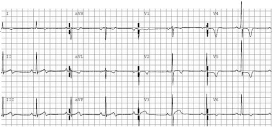 Inferolateral T Wave Inversion and ST Depression Evaluation of inferolateral TWI Additional testing to rule out cardiomyopathy