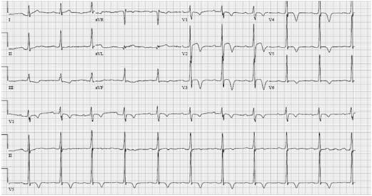 Note T wave inversions in I, avl, and V4 V6 (red arrows), as well as ST segment depression in V4 V5 (black arrows).