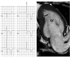 Evaluation of Lateral or Inferolateral TWI Comprehensive evaluation to r/o cardiomyopathy Echocardiogram Cardiac MRI should be a routine