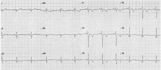 Panel A demonstrates physiologic repolarization in a black athlete with TWI in V1 V4 preceded by J point and convex domed ST segment elevation