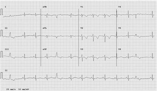 Anterior T Wave Inversion Evaluation of Anterior TWI The extent of investigation may vary based on clinical suspicion for ARVC and results from initial testing.