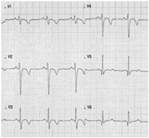 Epsilon Wave 2017 Athlete International Criteria : Distinct low amplitude signal (small positive deflection or notch) between the end of the QRS complex and onset of the T wave in leads V1 V3.
