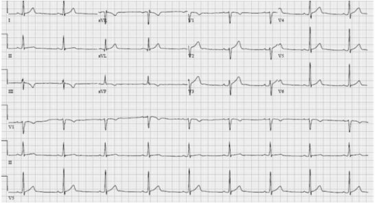 Inferior T Wave Inversion Normal or Abnormal?