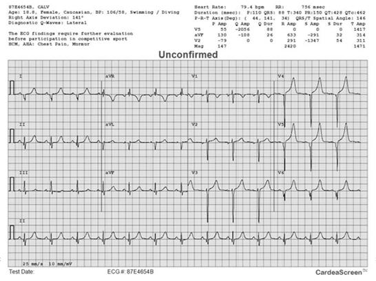ECG and no further evaluation is needed.