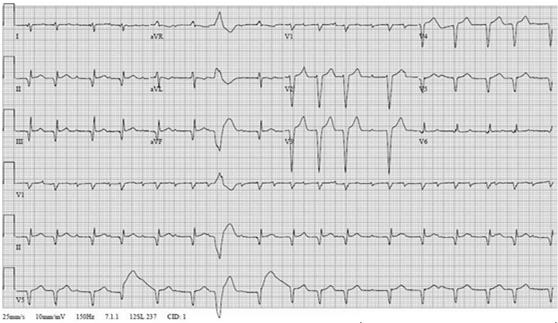 Pathologic Q Waves Q/R ratio 0.25 or 40 ms in duration ECG of a young patient with dilated cardiomyopathy.