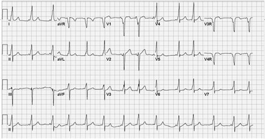 Ventricular Pre excitation / Wolff Parkinson White Delta wave ECG demonstrating the classic
