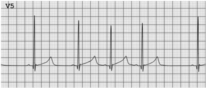 Abnormal notched T Wave morphology suggests LQT 2 Average QT interval 500 ms QT EVALUATION OF A PROLONGED QTc This alone is NOT a diagnosis of LQTS QTc < 470 ms males QTc < 480 ms females AND No