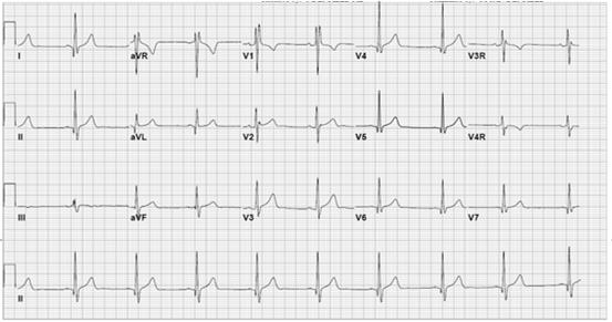 Incomplete Right Bundle Branch Block ECG demonstrates incomplete RBBB with rsr pattern in V1 and QRS duration of <120 ms.