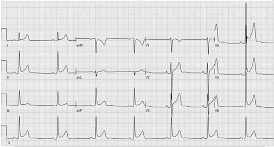 Early Repolarization >35mm ECG from a 29 year old asymptomatic soccer player demonstrating early repolarization (J point and ST