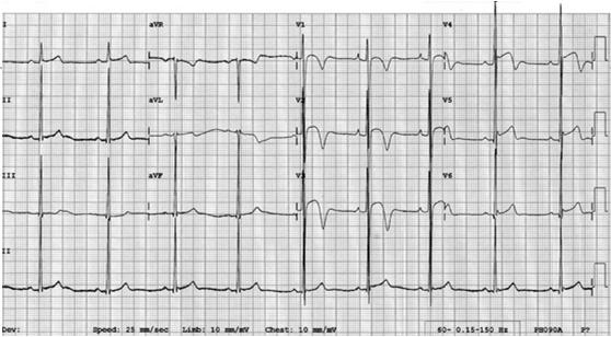 Black Athlete Repolarization Variant: Confined to Leads V1 V4 ECG from a black/african