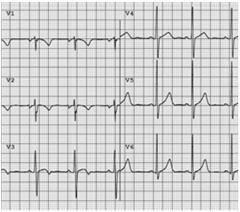 Juvenile T Wave Inversion ECG from a 12 year old asymptomatic Caucasian female soccer