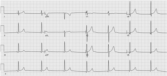 Junctional Escape Rhythm P wave P wave P waves hidden by QRS Complex A 28 year old Caucasian male demonstrating a junctional escape
