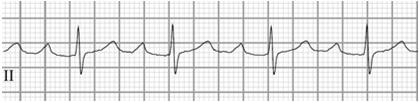 1 Atrioventricular Block PR ECG shows 1 ⁰ AV block (PR interval >200 ms).