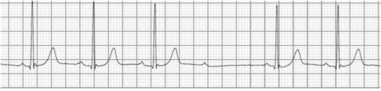 In this ECG tracing, the PR interval is constant from beat to beat and measures 300 ms.