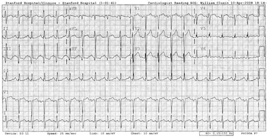 Left Atrial Enlargement ECG demonstrates left atrial enlargement, defined as a prolonged P wave duration of >120 ms in leads I or