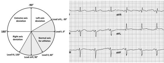 Left Axis Deviation ECG demonstrates abnormal left axis deviation defined as frontal plane QRS axis of less than 30.