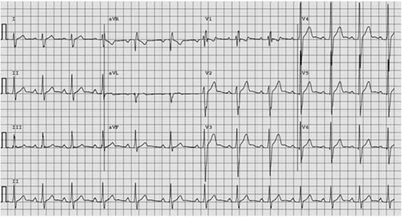 Right Bundle Branch Block R S wave V6 19 yo Caucasian male athlete with complete RBBB.