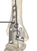 STEP 1 - Plate Placement Place the Align Anterior Fusion Plate so that the lateral tab rests lateral to the talar neck and the proximal end of the plate rests on the anterolateral aspect of the tibia.