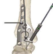 Subsequently add a second Olive Wire in the tibia in either the slotted fixation hole or the axial compression slot.