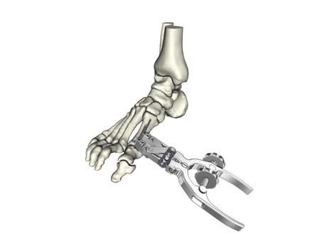 Once the established position has been selected either side of the osteotomy site, insert K-Wires (1.8mm or 2.0mm) through the device jaws. Distal holes will accept 1.8mm K-wires.