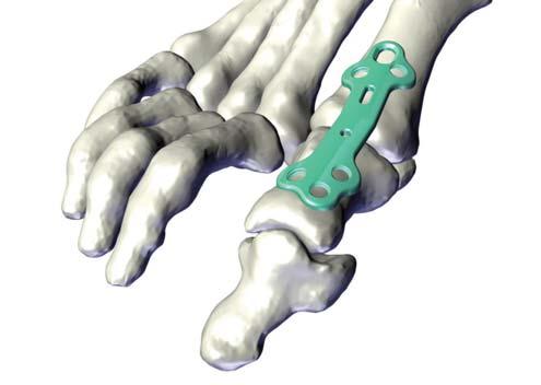 Plate Selection and Positioning The valgus transition and resection indication line on the MTP plate can be used to identify the valgus transition point and ideal joint