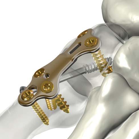5mm cannulated screw can be inserted across the osteotomy or fusion sites to strengthen the construct and increase the likelihood of bone fusion. 2 3.