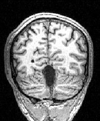 Structural MRI sequences Chronic focal lesions (stroke