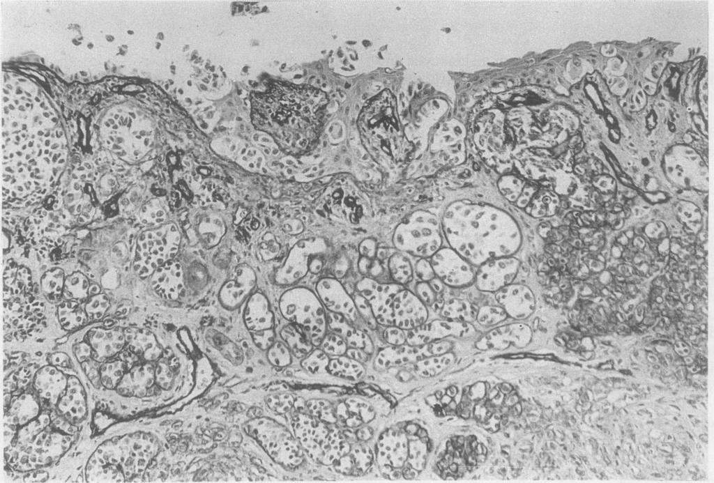 intraepidermal component ofmelanoma. Note in-built positive controlprovided by the blood vessel staining. J Clin Pathol: first published as 10.1136/jcp.42.11.1173 on 1 November 1989.