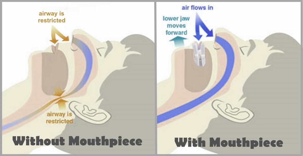 Where s the Mouthpiece? Also known as a jaw holding mouthpiece works by moving your jaw into a forward position and retaining it during sleep.
